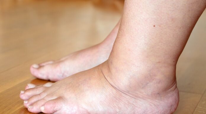 Why Do Seniors Experience Swollen Legs? Causes and Simple Solutions
