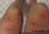 Unexplained Bruising on Your Body: Causes and Treatments