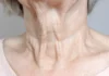 Why Neck Skin Sags with Age