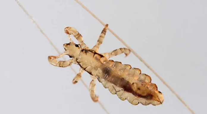 Doctors Will not Tell You this- Cheap Way to Get Rid of Lice Instantly