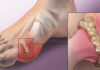How To Quickly Reduce Uric Acid Crystallization To Help Prevent Gout and Joint Pain