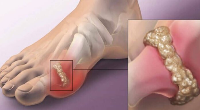 How To Quickly Reduce Uric Acid Crystallization To Help Prevent Gout and Joint Pain