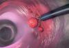 If You Have Colon Polyps, These 4 Symptoms During Bowel Movements Could Be a Warning — See a Doctor Before It’s Too Late
