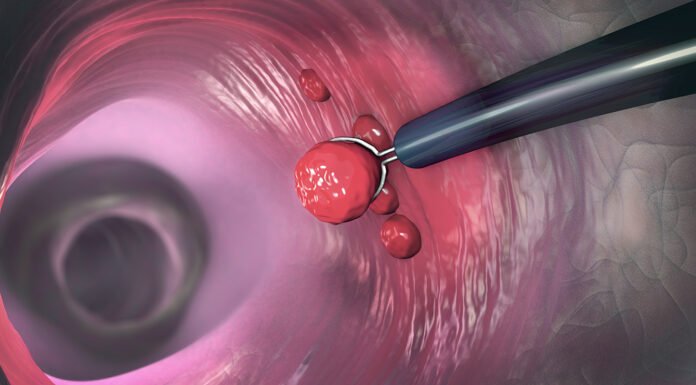 If You Have Colon Polyps, These 4 Symptoms During Bowel Movements Could Be a Warning — See a Doctor Before It’s Too Late