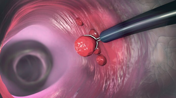 CW_colon_polyps_G1136901766_EC