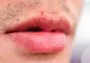 If You Are Getting White Pimples on Your Lips or Intimate Area, Here’s What They Could Mean