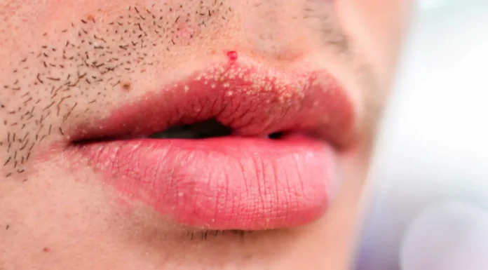 If You Are Getting White Pimples on Your Lips or Intimate Area, Here’s What They Could Mean