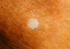 Tiny White Spots on Your Arms or Legs? Here’s What They Could Be Telling You