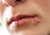 These Are Contagious When You Have Se.xual Relations: What You Should Know About Cold Sores and the Virus Behind Them
