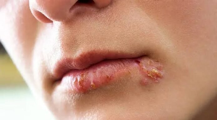 These Are Contagious When You Have Se.xual Relations: What You Should Know About Cold Sores and the Virus Behind Them
